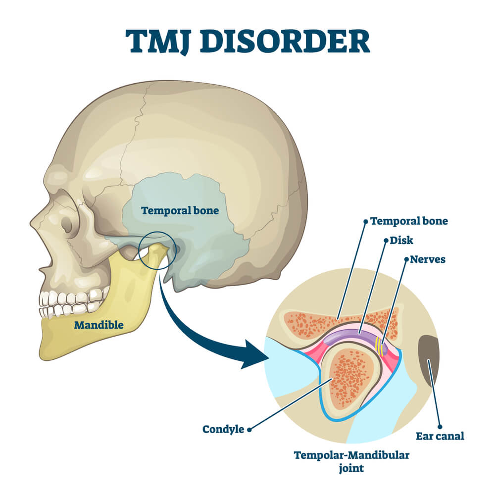 TMJ disorder diagram with joint clicking and pain anatomical structure and explanation