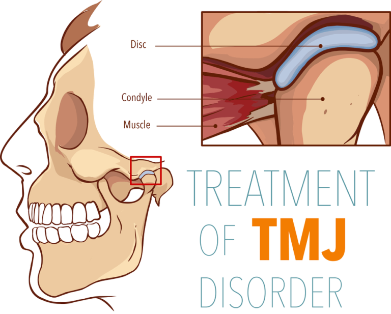 treatment of tmj disorder