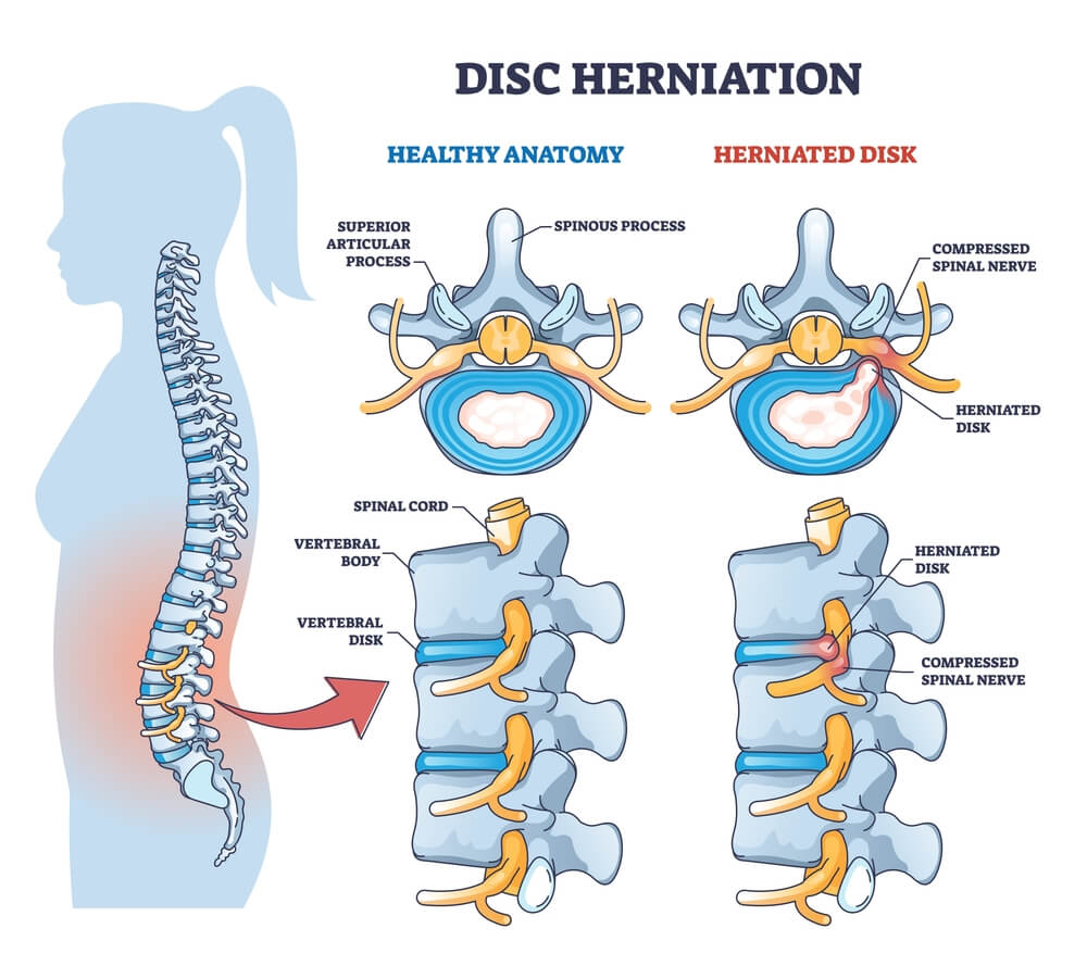 Disc herniation treatment