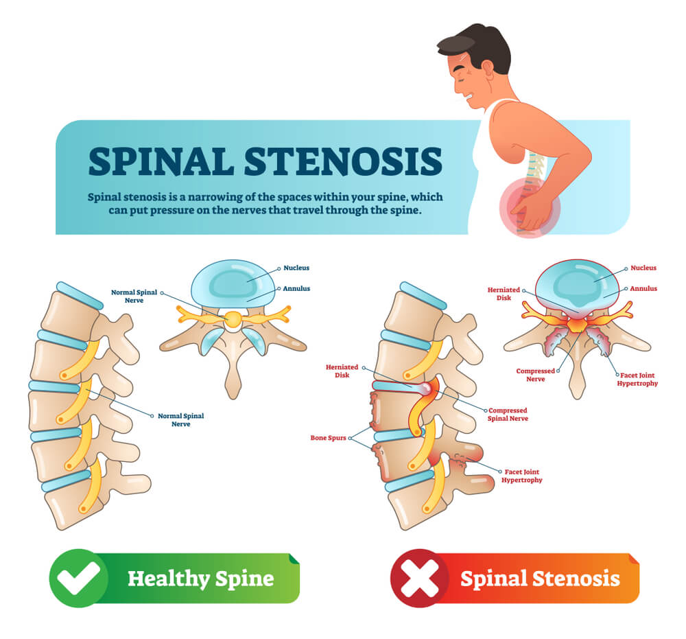 spinal stenosis treatment