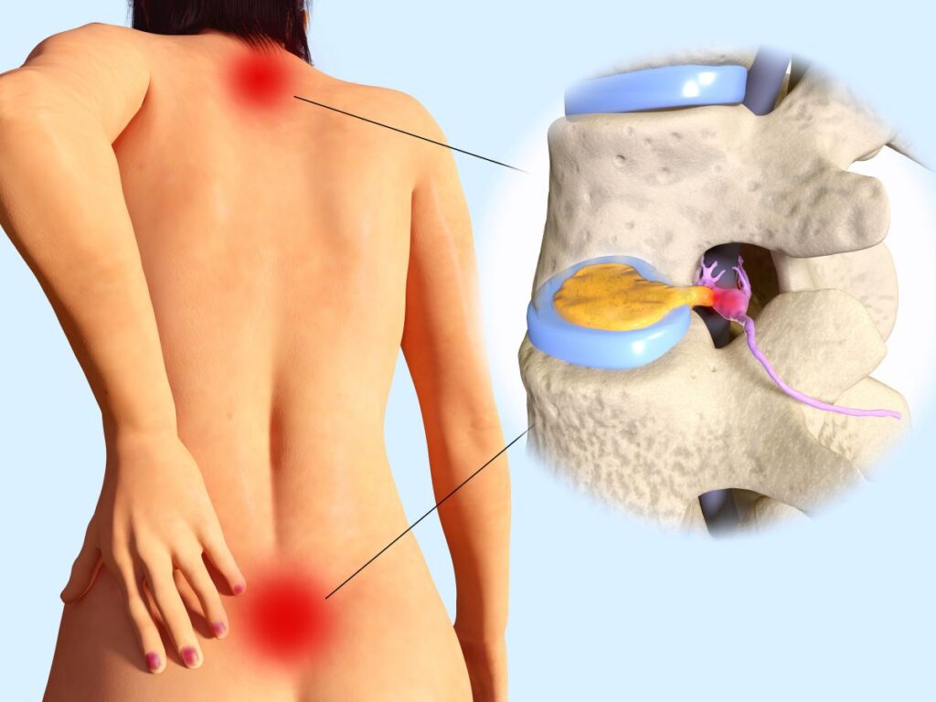 Spinal Decompression for Degenerative Disc Disease