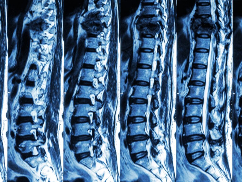 Spinal Cord Injury Recovery